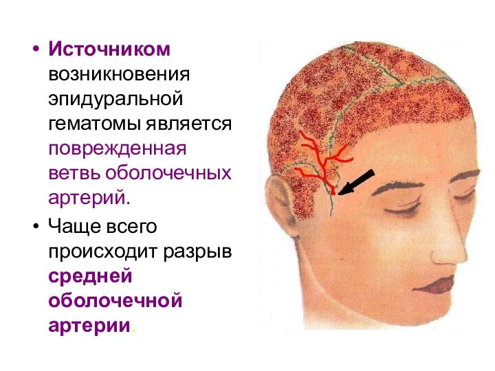 Источником возникновения эпидуральной гематомы является поврежденная ветвь оболочечных артерий. Чаще всего происходит разрыв средней оболочечной артерии.