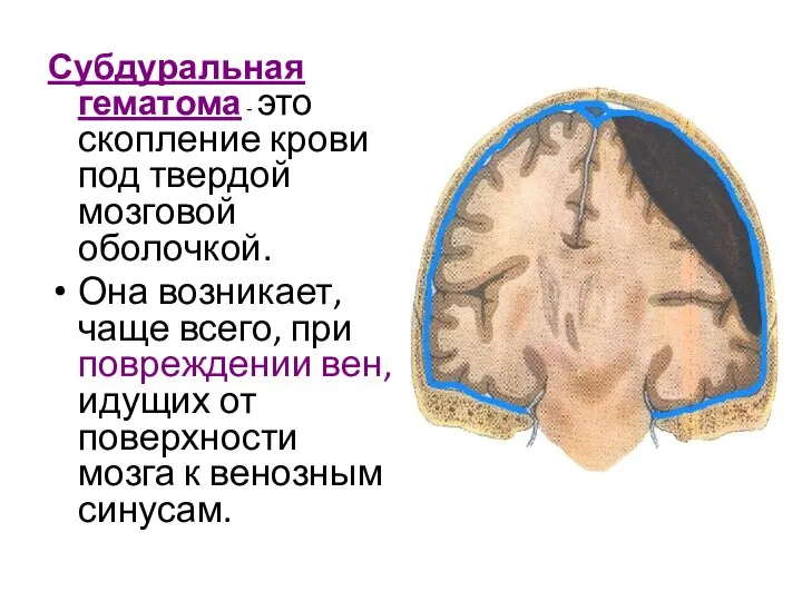 Субдуральная гематома - это скопление крови под твердой мозговой оболочкой. Она возникает,