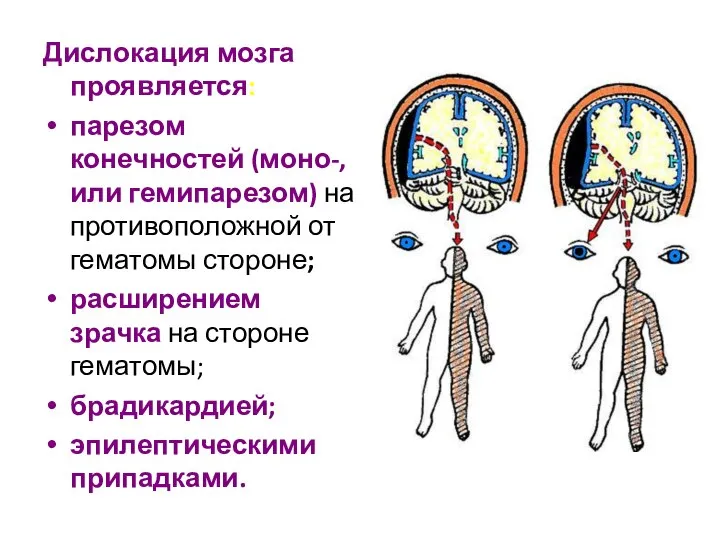 Дислокация мозга проявляется: парезом конечностей (моно-, или гемипарезом) на противоположной от гематомы