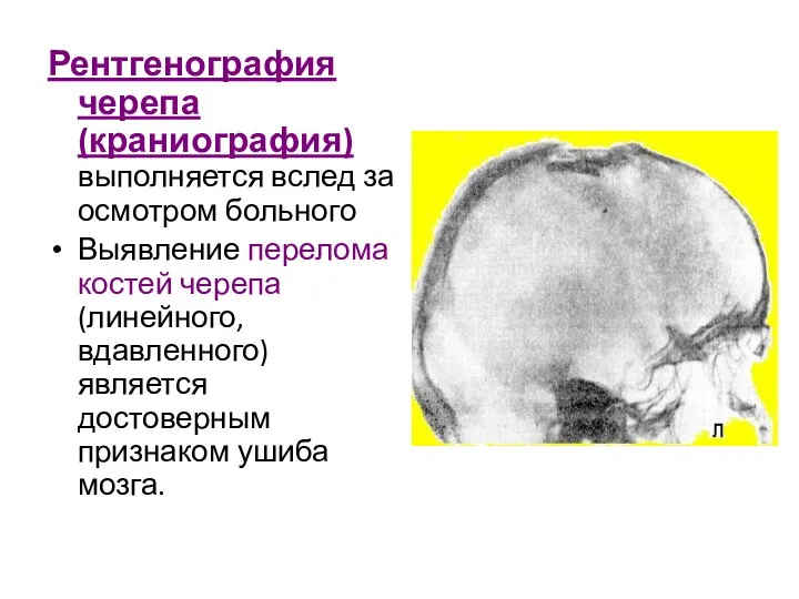 Рентгенография черепа (краниография) выполняется вслед за осмотром больного Выявление перелома костей черепа