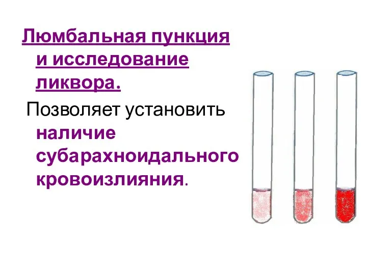 Люмбальная пункция и исследование ликвора. Позволяет установить наличие субарахноидального кровоизлияния.