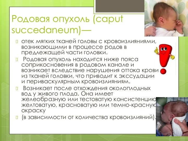 Родовая опухоль (caput succedaneum)— отек мягких тканей головы с кровоизлияниями, возникающими в