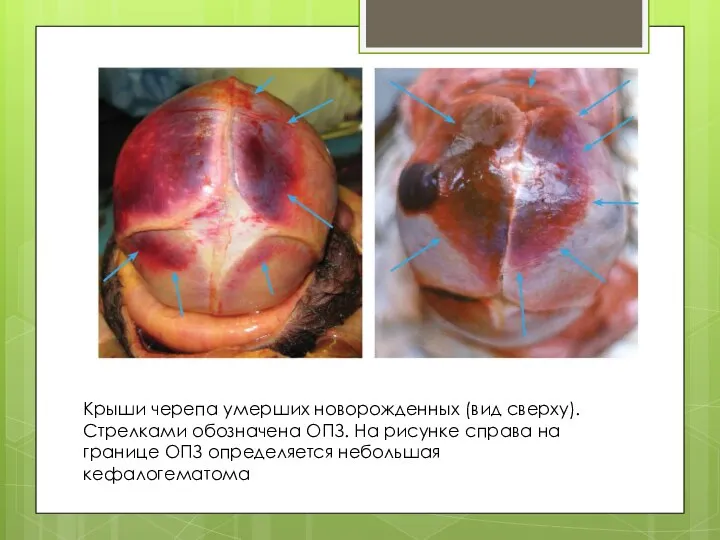 Крыши черепа умерших новорожденных (вид сверху). Стрелками обозначена ОПЗ. На рисунке справа