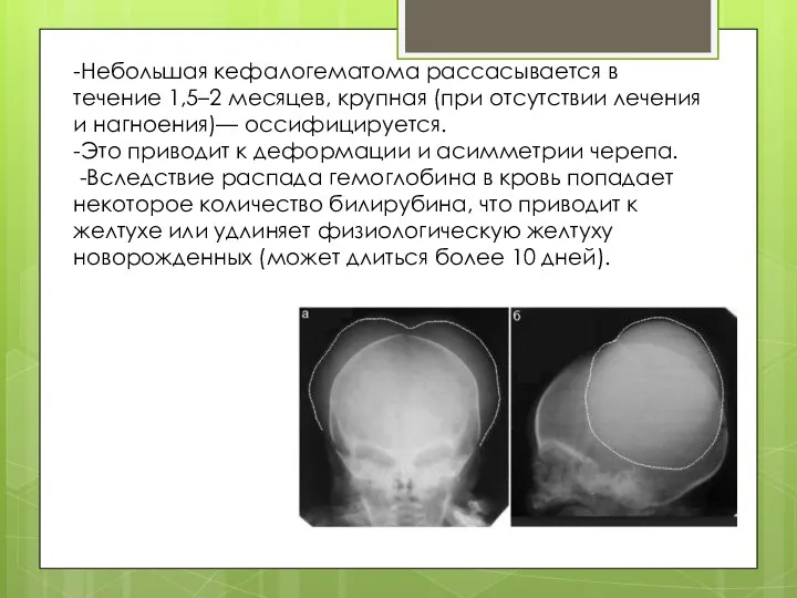 -Небольшая кефалогематома рассасывается в течение 1,5–2 месяцев, крупная (при отсутствии лечения и