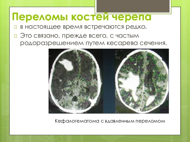 Переломы костей черепа в настоящее время встречаются редко. Это связано, прежде всего,