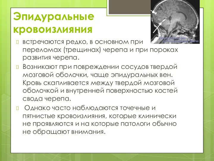 Эпидуральные кровоизлияния встречаются редко, в основном при переломах (трещинах) черепа и при