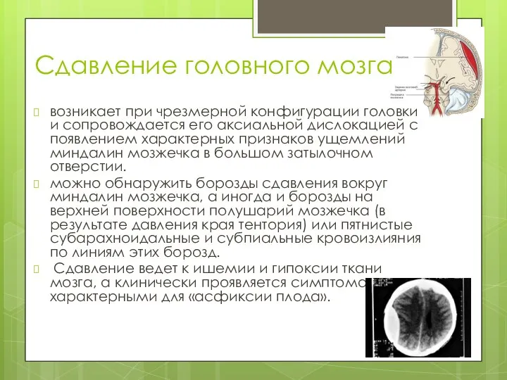 Сдавление головного мозга возникает при чрезмерной конфигурации головки и сопровождается его аксиальной