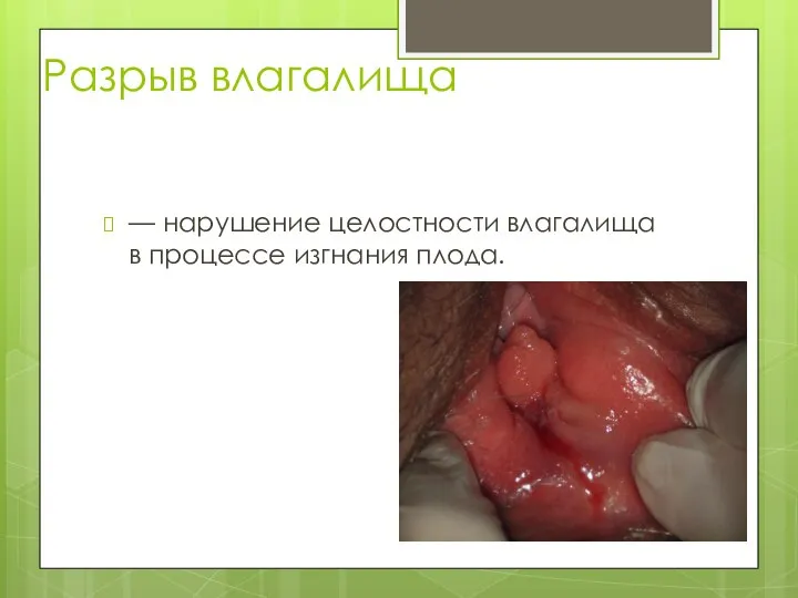 Разрыв влагалища — нарушение целостности влагалища в процессе изгнания плода.