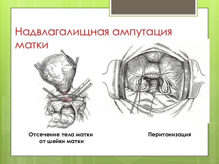 Надвлагалищная ампутация матки Отсечение тела матки от шейки матки Перитонизация