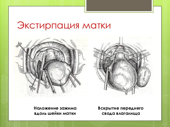 Экстирпация матки Наложение зажима вдоль шейки матки Вскрытие переднего свода влагалища