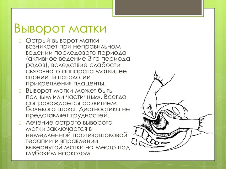 Выворот матки Острый выворот матки возникает при неправильном ведении последового периода (активное