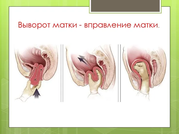 Выворот матки - вправление матки.