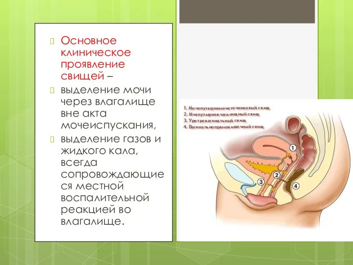 Основное клиническое проявление свищей – выделение мочи через влагалище вне акта мочеиспускания,