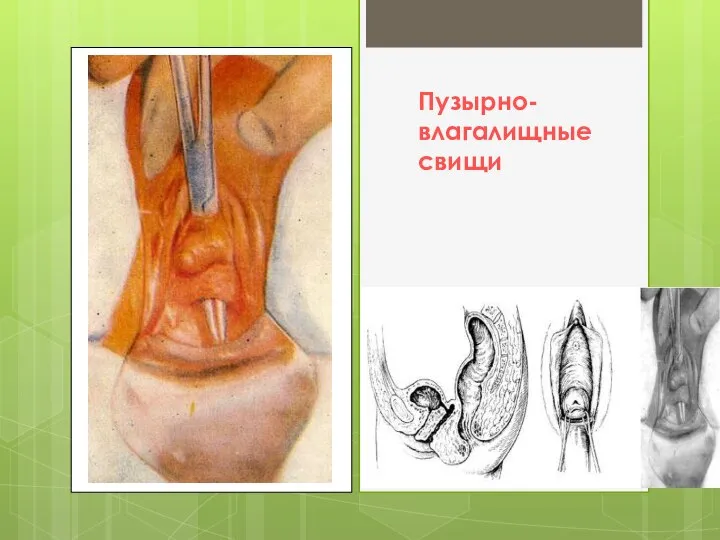 Пузырно-влагалищные свищи