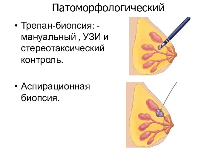 Трепан-биопсия: - мануальный , УЗИ и стереотаксический контроль. Аспирационная биопсия. Патоморфологический