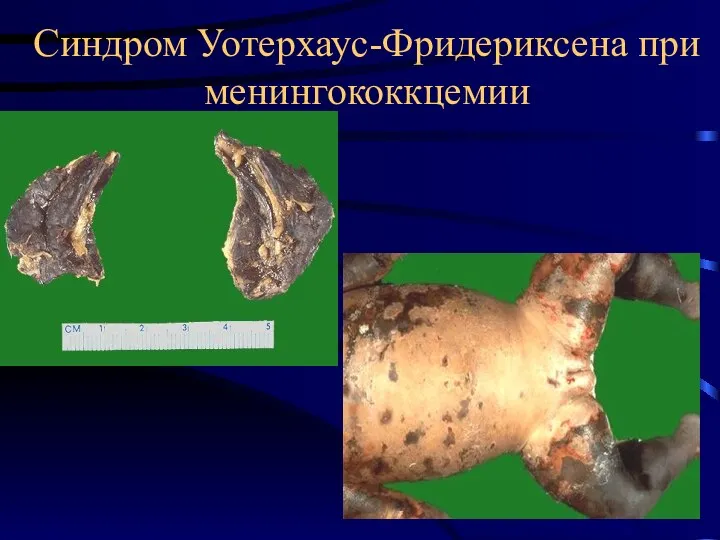 Синдром Уотерхаус-Фридериксена при менингококкцемии