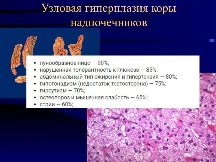 Узловая гиперплазия коры надпочечников