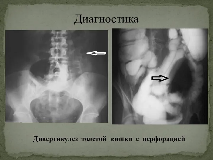 Диагностика Дивертикулез толстой кишки с перфорацией