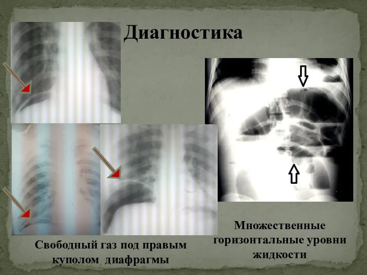 Диагностика Свободный газ под правым куполом диафрагмы Множественные горизонтальные уровни жидкости