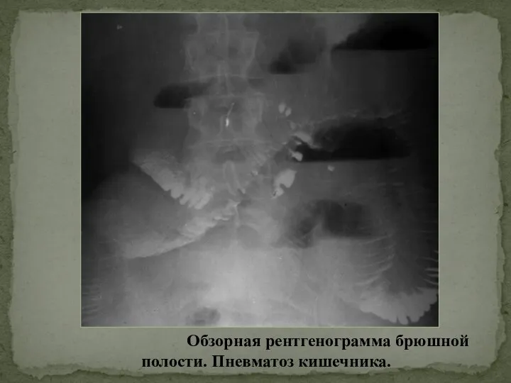 Обзорная рентгенограмма брюшной полости. Пневматоз кишечника.