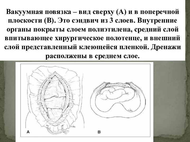 Вакуумная повязка – вид сверху (A) и в поперечной плоскости (B). Это