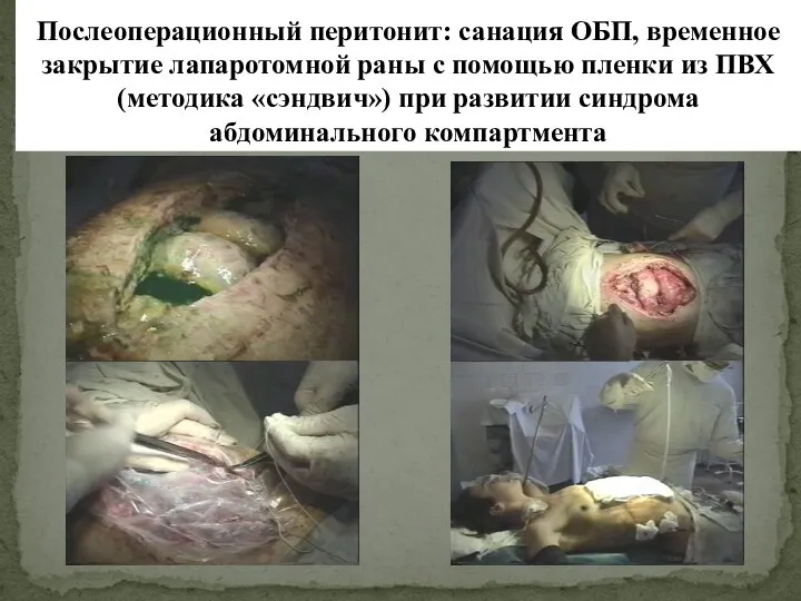 Послеоперационный перитонит: санация ОБП, временное закрытие лапаротомной раны с помощью пленки из