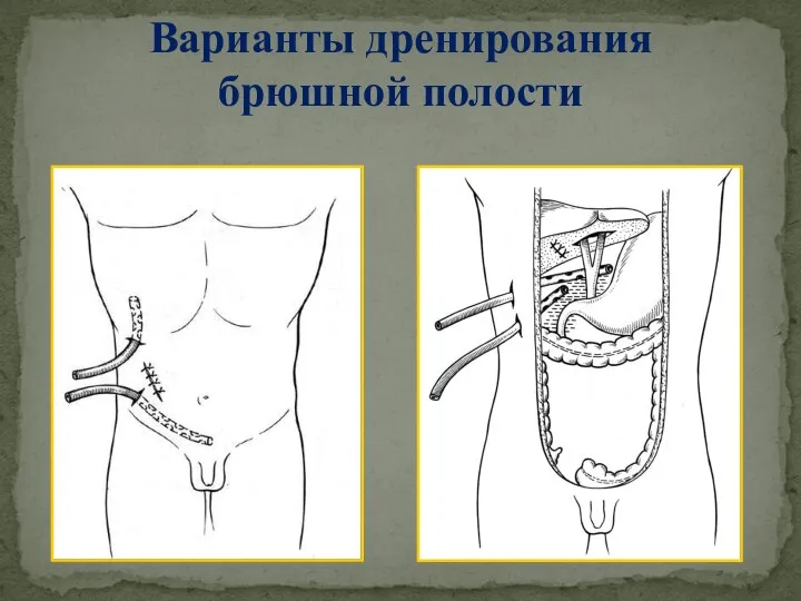 Варианты дренирования брюшной полости