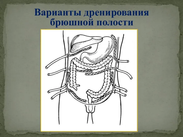 Варианты дренирования брюшной полости