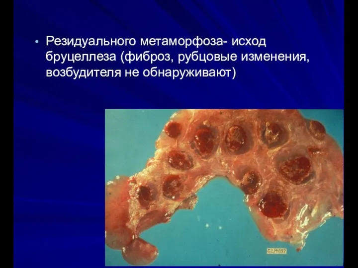 Резидуального метаморфоза- исход бруцеллеза (фиброз, рубцовые изменения, возбудителя не обнаруживают)