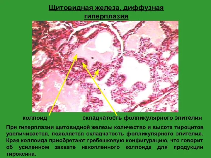 Щитовидная железа, диффузная гиперплазия При гиперплазии щитовидной железы количество и высота тироцитов