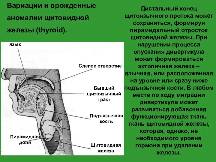 Вариации и врожденные аномалии щитовидной железы (thyroid). Дистальный конец щитоязычного протока может