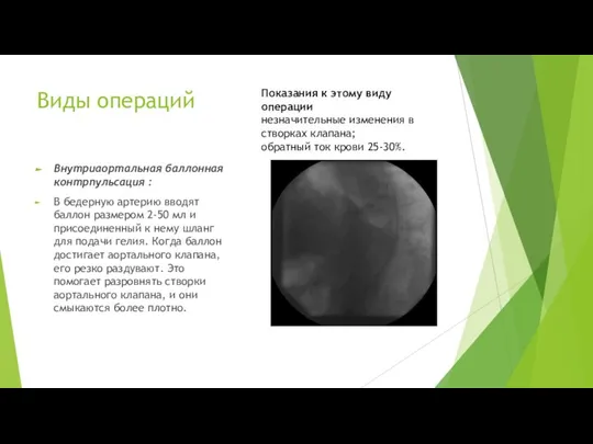 Виды операций Внутриаортальная баллонная контрпульсация : В бедерную артерию вводят баллон размером