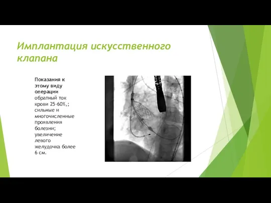 Имплантация искусственного клапана Показания к этому виду операции обратный ток крови 25-60%,;