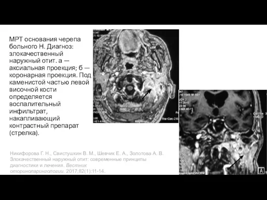 МРТ основания черепа больного Н. Диагноз: злокачественный наружный отит. а — аксиальная