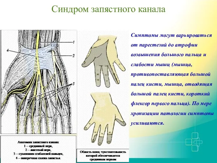 Синдром запястного канала Симптомы могут варьироваться от парестезий до атрофии возвышения большого