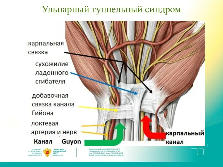 Ульнарный туннельный синдром