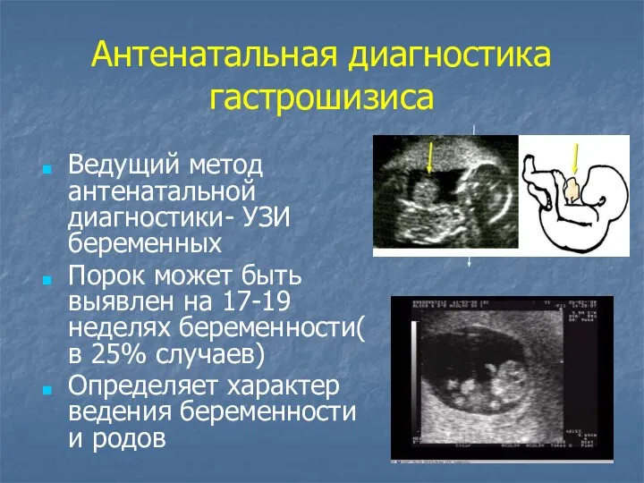 Антенатальная диагностика гастрошизиса Ведущий метод антенатальной диагностики- УЗИ беременных Порок может быть