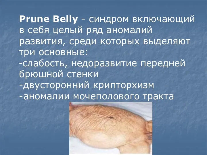 Prune Belly - синдром включающий в себя целый ряд аномалий развития, среди