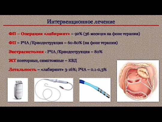 Интервенционное лечение ФП – Операция «лабиринт» – 92% (36 месяцев на фоне