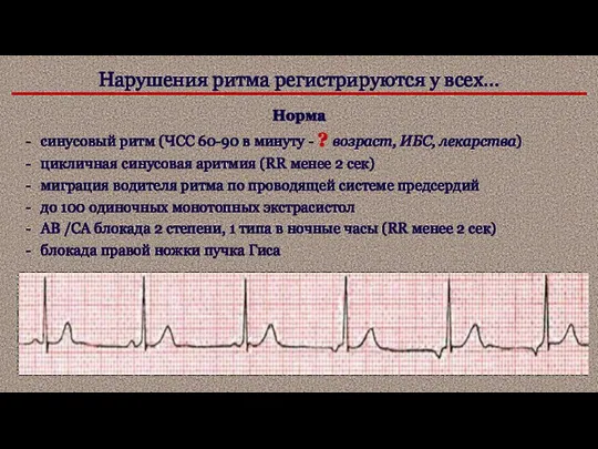 Нарушения ритма регистрируются у всех… Норма синусовый ритм (ЧСС 60-90 в минуту