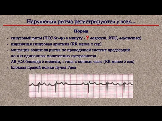 Нарушения ритма регистрируются у всех… Норма синусовый ритм (ЧСС 60-90 в минуту