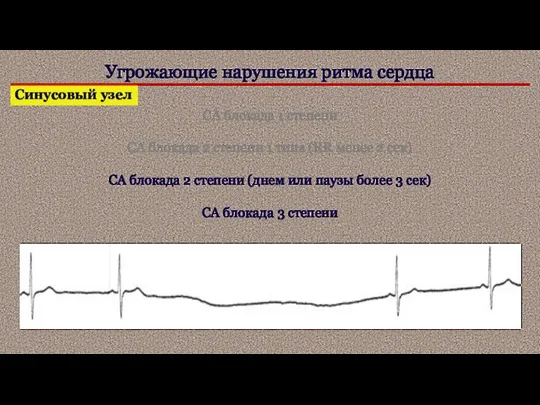 Угрожающие нарушения ритма сердца Синусовый узел СА блокада 1 степени СА блокада