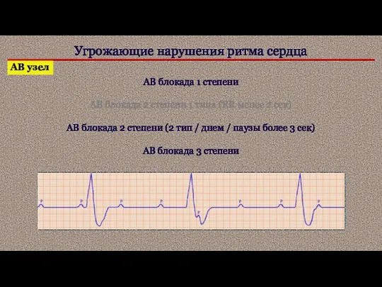 Угрожающие нарушения ритма сердца АВ узел АВ блокада 1 степени АВ блокада