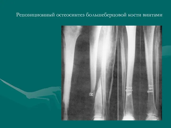 Репозиционный остеосинтез большеберцовой кости винтами