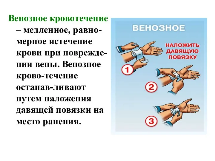 Венозное кровотечение – медленное, равно-мерное истечение крови при поврежде-нии вены. Венозное крово-течение