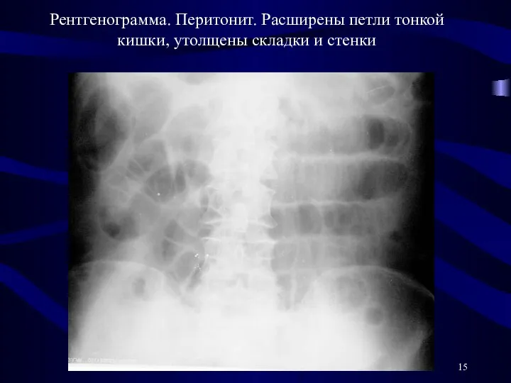 Рентгенограмма. Перитонит. Расширены петли тонкой кишки, утолщены складки и стенки