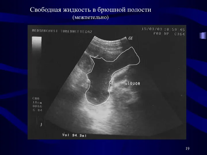 Свободная жидкость в брюшной полости (межпетельно)