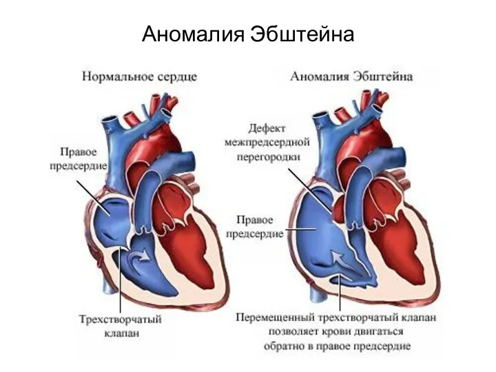 Аномалия Эбштейна