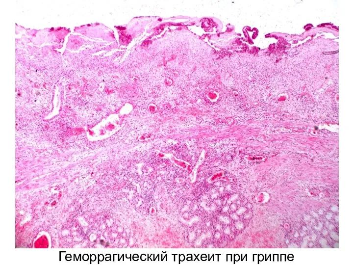 Геморрагический трахеит при гриппе