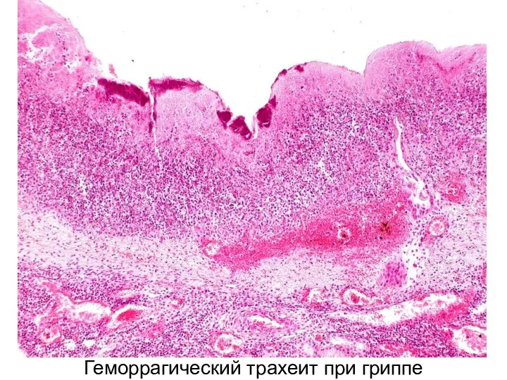 Геморрагический трахеит при гриппе